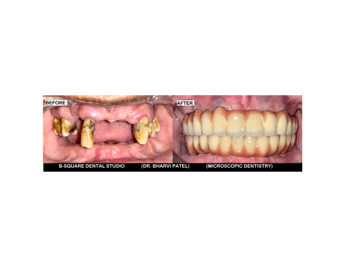 Full mouth rehabilitation with Dental Implant
