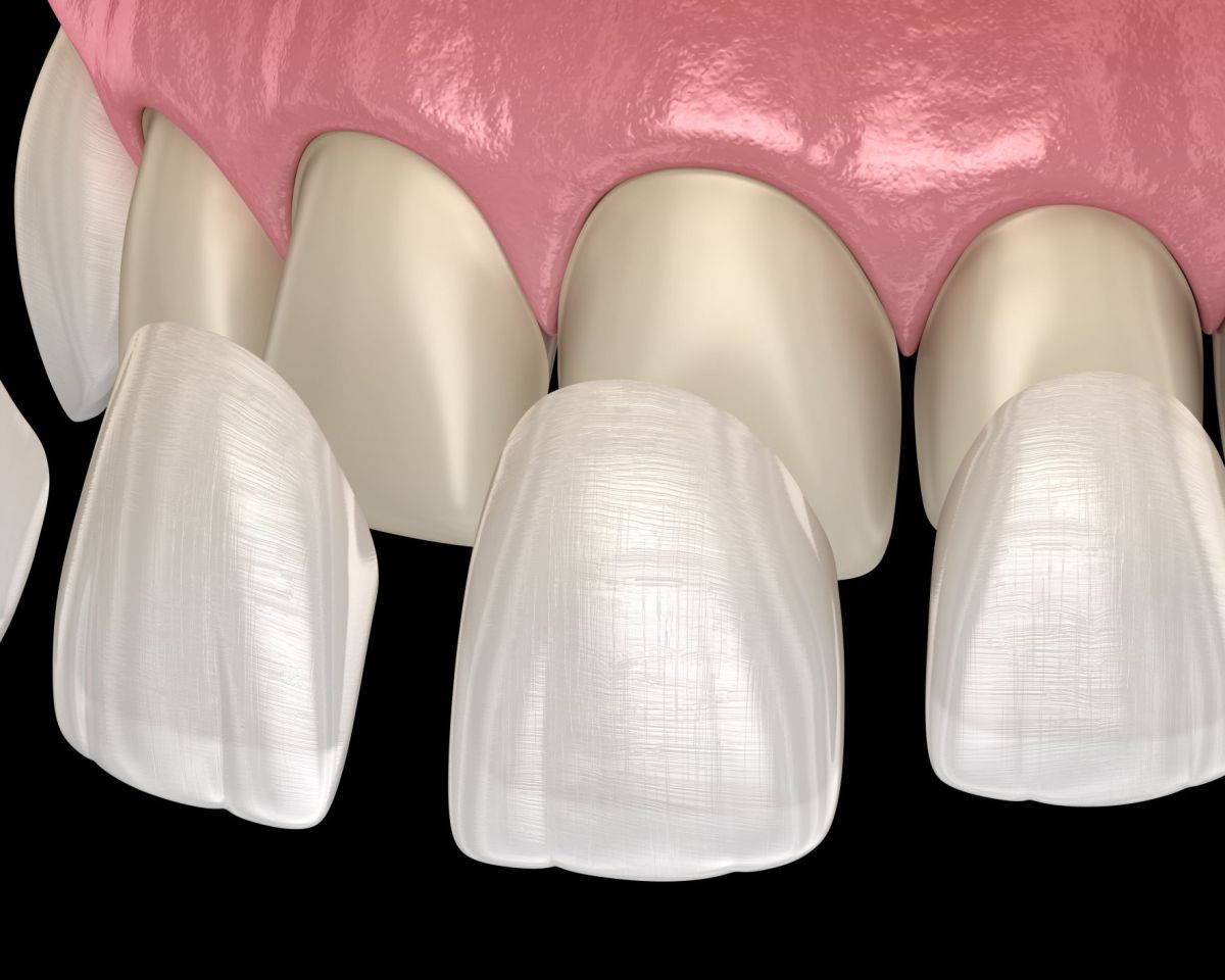 Porcelain Veneers: What Patients Usually Ask Before They Decide