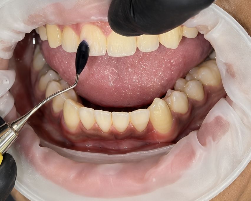 Direct Composite Veneers: A Simple Way to Improve Your Smile Without Major Dental Work