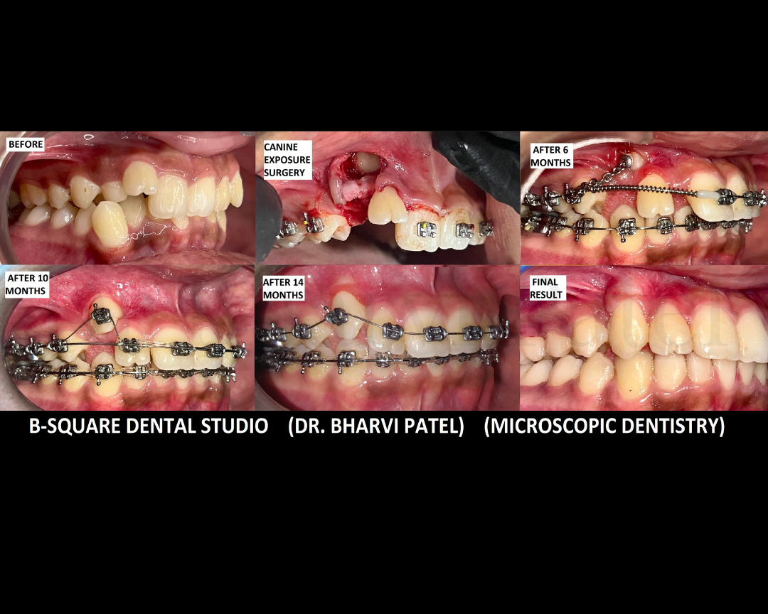 Management of an impacted canine through surgical exposure and braces assisted eruption