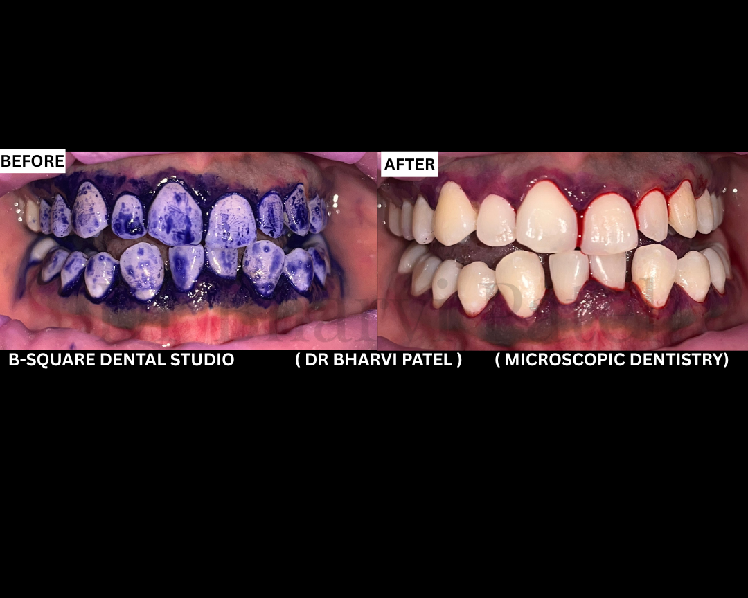 Stop scaling blindly. Stop missing biofilm.    Start guided. Start precise. GBT   "the future of dental cleaning is already here.”