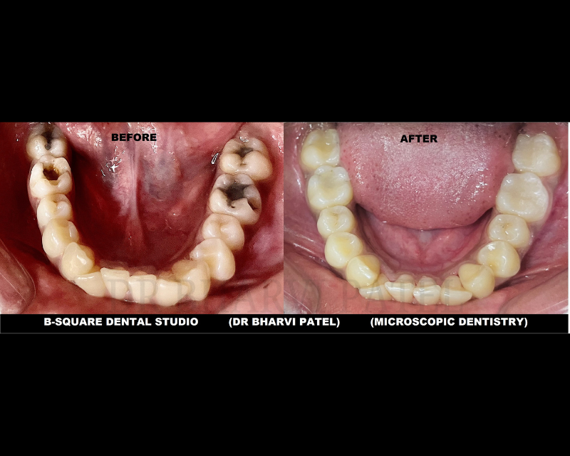 One teeth ,one session .  zero evidence It was ever broken. "composite restoration " where dentistry meets artistry