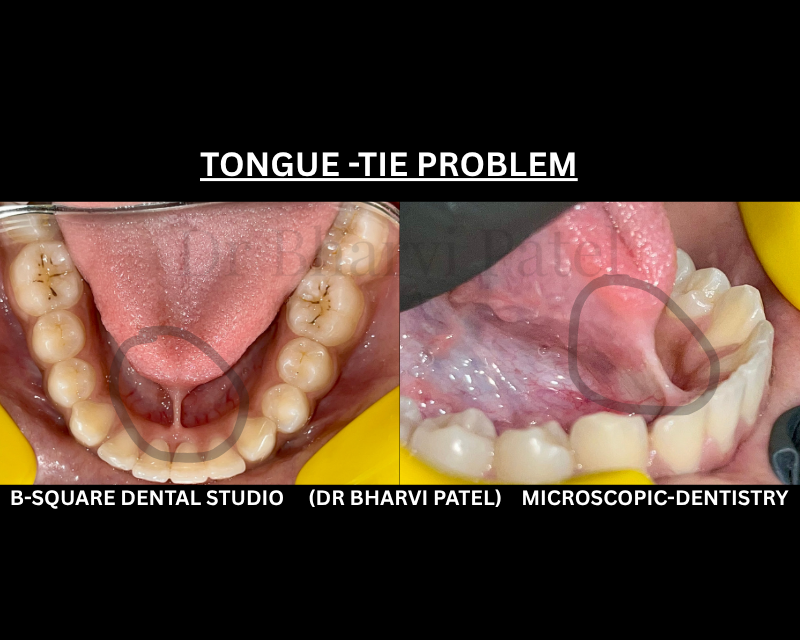 "TONGUE TIE ISN'T JUST A BABY PROBLEM.ADULT LIVE WITH IT UNDIAGNOSED THEIR WHOLE LIVE ."