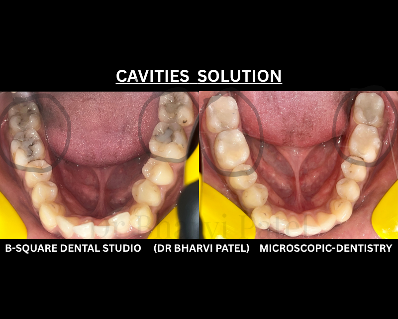 One teeth ,one session . zero evidence It was ever broken. "composite restoration " where dentistry meets artistry