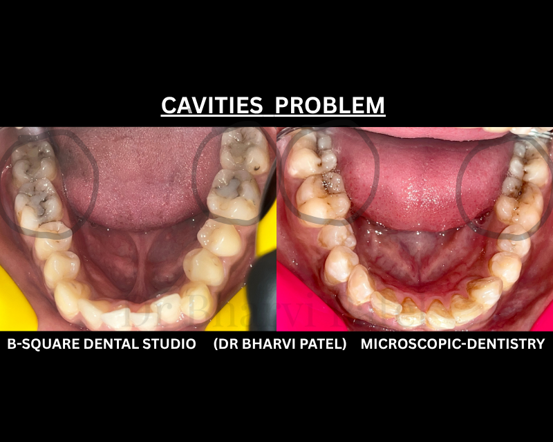 Cavities don't start with a hole. They start invisible, inside the enamel, long before you can see anything .