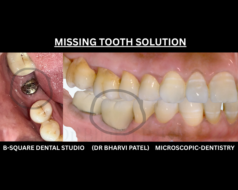 That temporary gap has been there for  more than 3 years . it's not temporary anymore . replace missing teeth with DENTAL IMPLANT .20