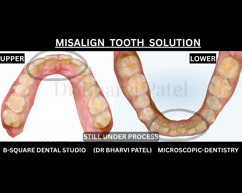 Nobody clocked the aligners , Everyone clocked the confidence . Invisible to everyone else . Visible in every photo after .