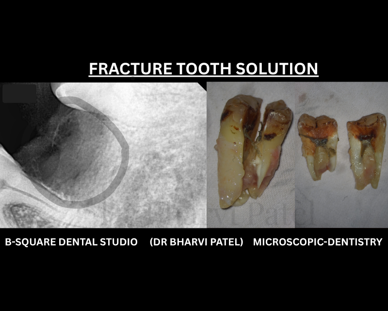 The longer a cracked tooth sits there , more the infection spreads toward the bone . Teeth removal (extraction ) heals your pain .