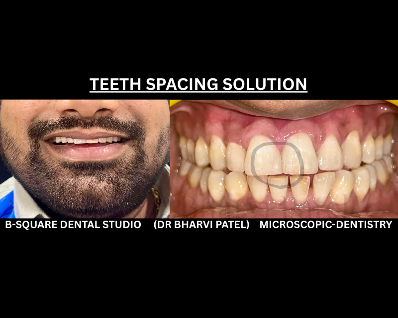 One appointment . Zero drilling in to healthy tooth structure . A  completely different smile  with COMPOSITE VENNER .