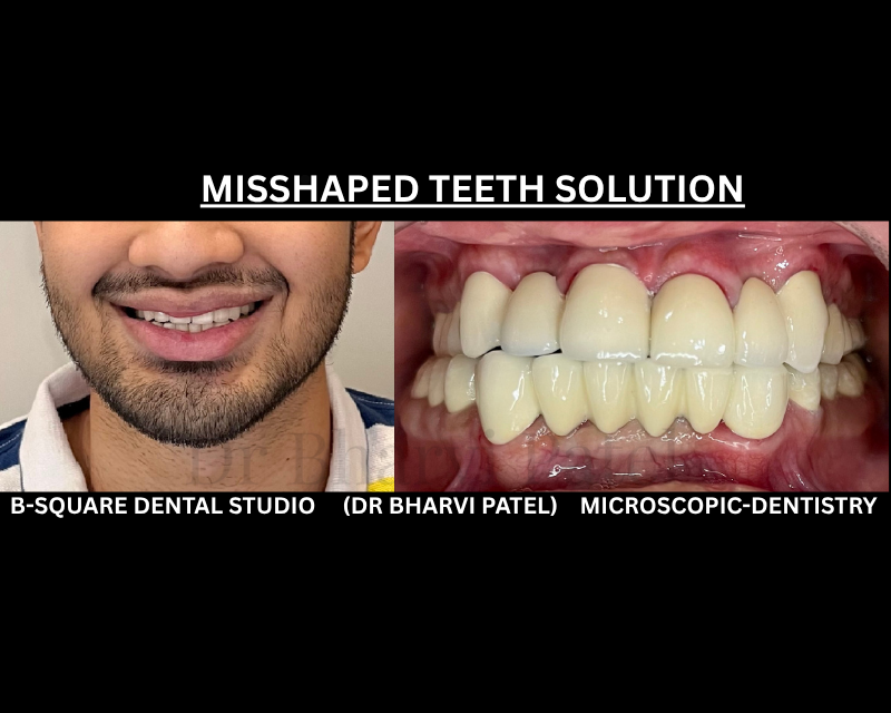 full mouth rehabilitation isn't just for extreme cases but it's for everyone whose small problems pilled up in to one big one .