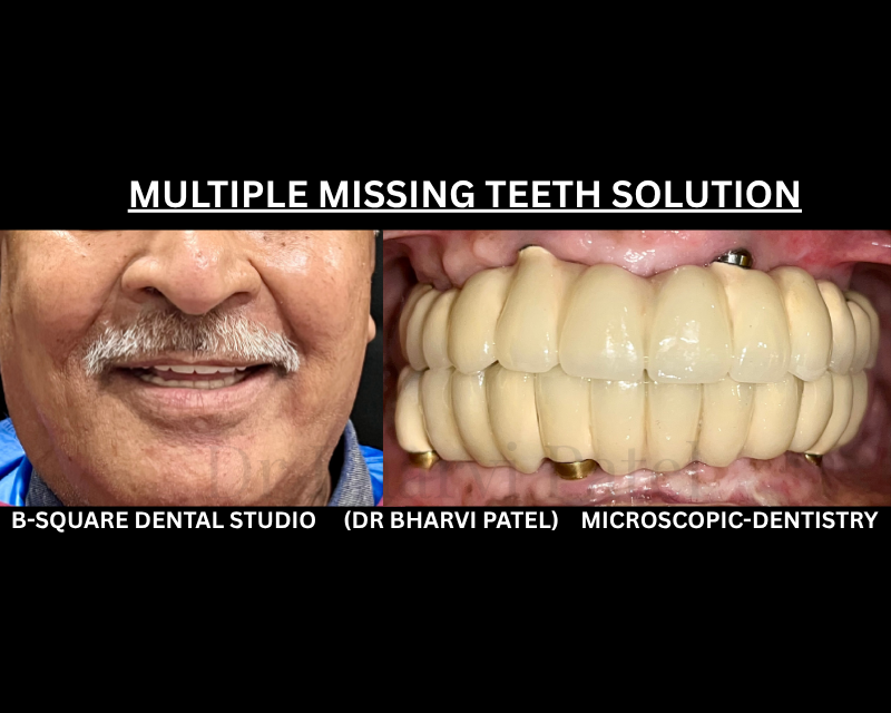 You don't need a full set of natural teeth to eat a steak again . Just the right implant in the right places do it all  . full mouth dental implant gives you another life to chew naturally .
