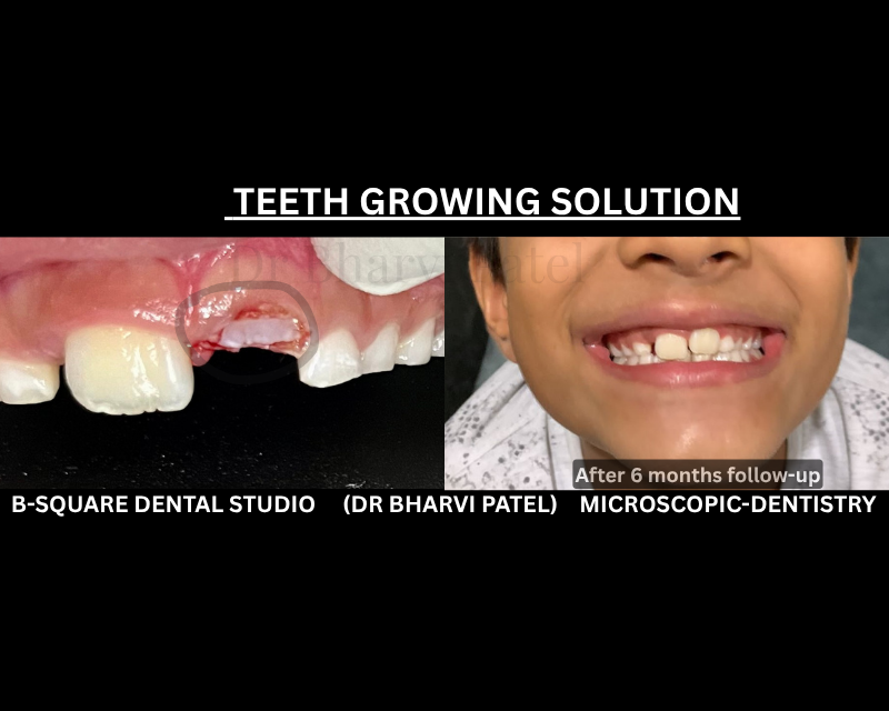 A few seconds of cautery , and the tooth that's been ' delayed ' for months finally has a clear path .