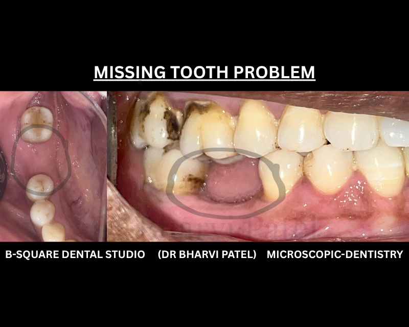 A missing tooth doesn't stay a one tooth problem. The teeth around it start shifting to fill the space .