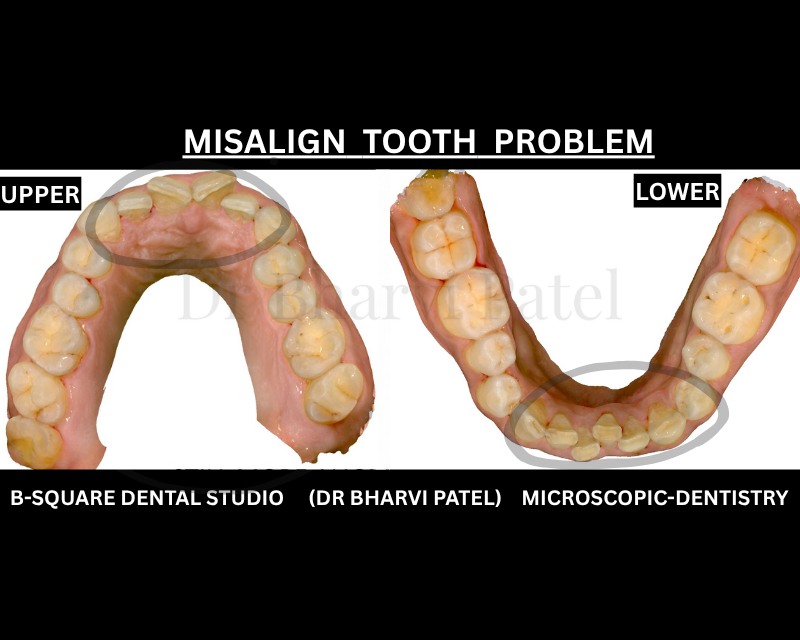 Misaligned teeth wear down faster than straight ones. You're literally grinding away your own enamel unevenly.