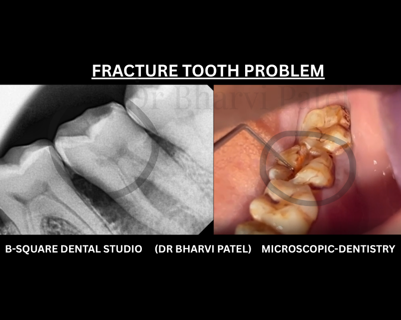 A badly fractured tooth left in place doesn't just sit there ,it become an entry point for infection .