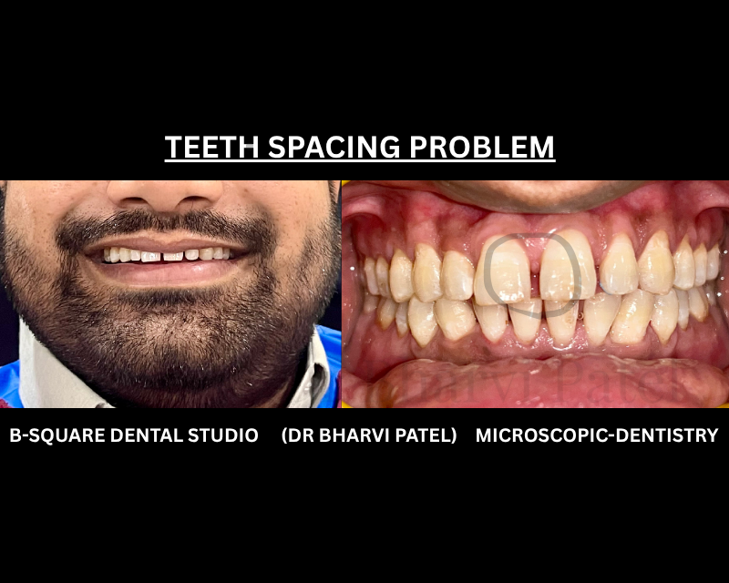 A gap between front teeth doesn't close on its own ,it can actually widen slightly over time .