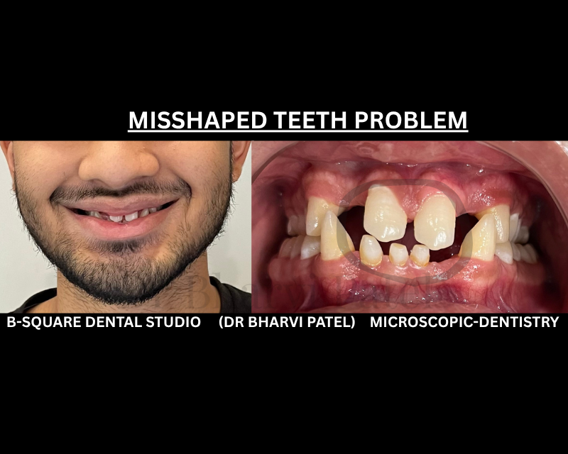 Misshaped teeth aren't always one problem . sometime it's years of small wear ,chips, and shifts adding up together .
