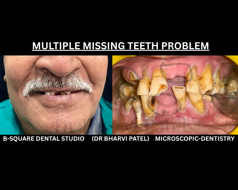 Multiple missing teeth don't just affect how you chew , they change the shape of your face over time .