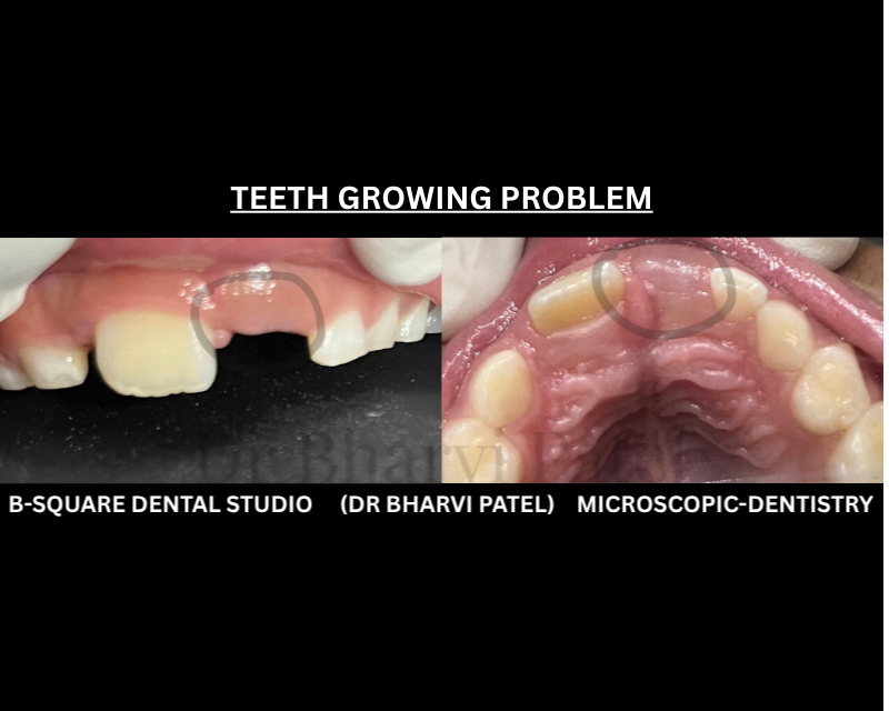 A delayed front tooth doesn't always mean a developmental issue . often ,it's simply thick gum tissue covering it .