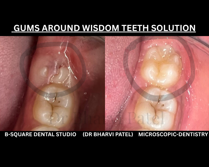 A tooth can be perfectly healthy and still cause pain  because of a flap of gum sitting right on top of it ( peri coronal flap removal treatment by cautery treatment )