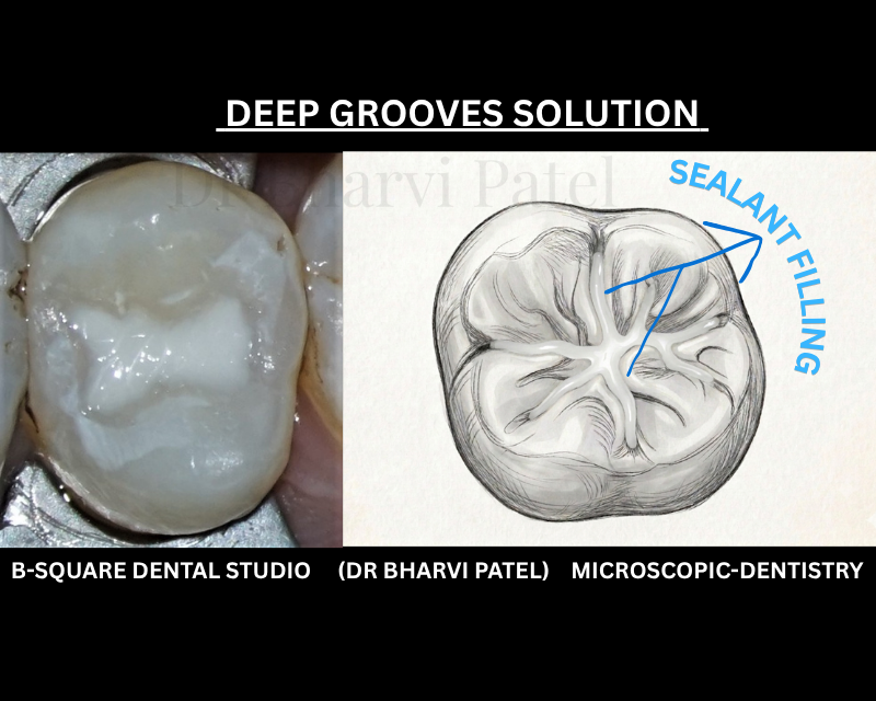 One thin protective coating,  painted in minutes,  and those deep grooves stop being a hiding spot for bacteria.