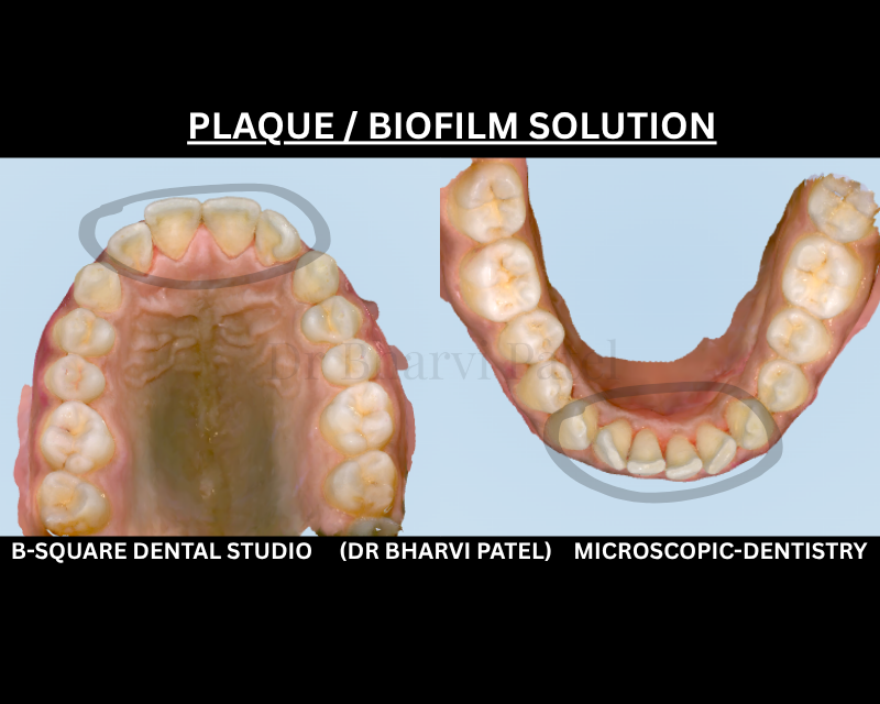 "Biofilm left undisturbed doesn't just sit there , it hardens into tartar, and tartar leads to gum disease. This Biofilm removing by guided biofilm theraphy.