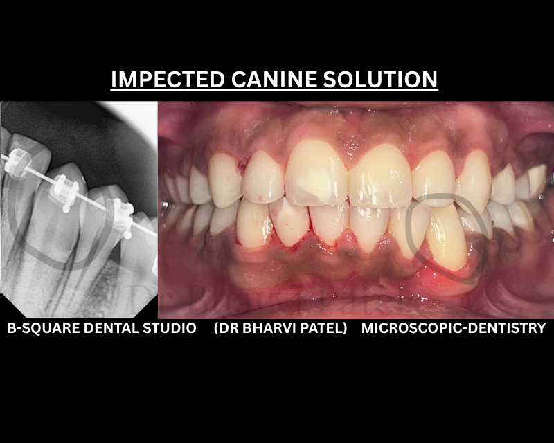 An impacted canine can sit trapped in the jawbone for years, quietly affecting how neighboring teeth are positioned. naturally guide to erupting by Dental braces treatment.