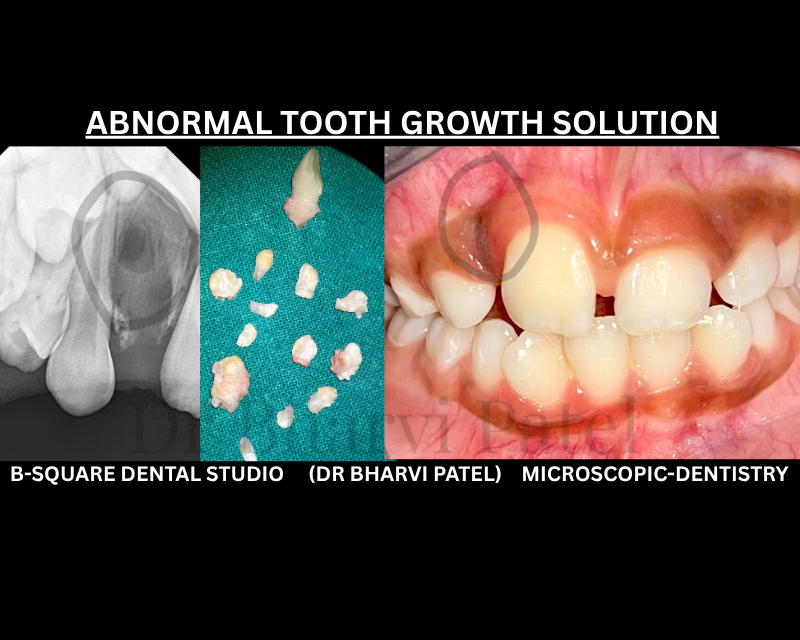 An untreated odontoma (multiple teeth like structure ) doesn't just block eruption , it can keep growing and affect surrounding teeth and bone over time.