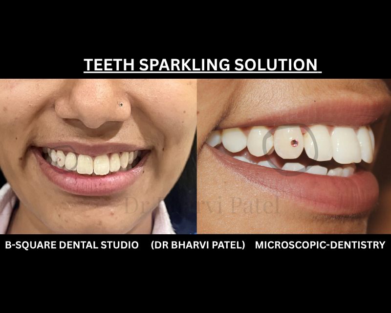 No drilling, no damage to the tooth , just a sparkle that wasn't there yesterday by One tiny crystal, bonded to your tooth in minutes .