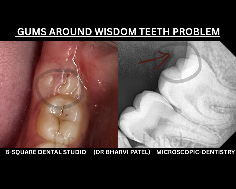 That nagging pain at the back of your mouth? Your wisdom tooth isn't the problem your gum is trying to tell you something.