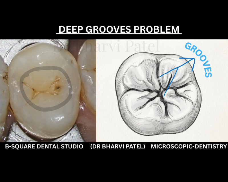 Deep grooves don't get shallower or easier to clean with time , they just keep collecting more plaque."