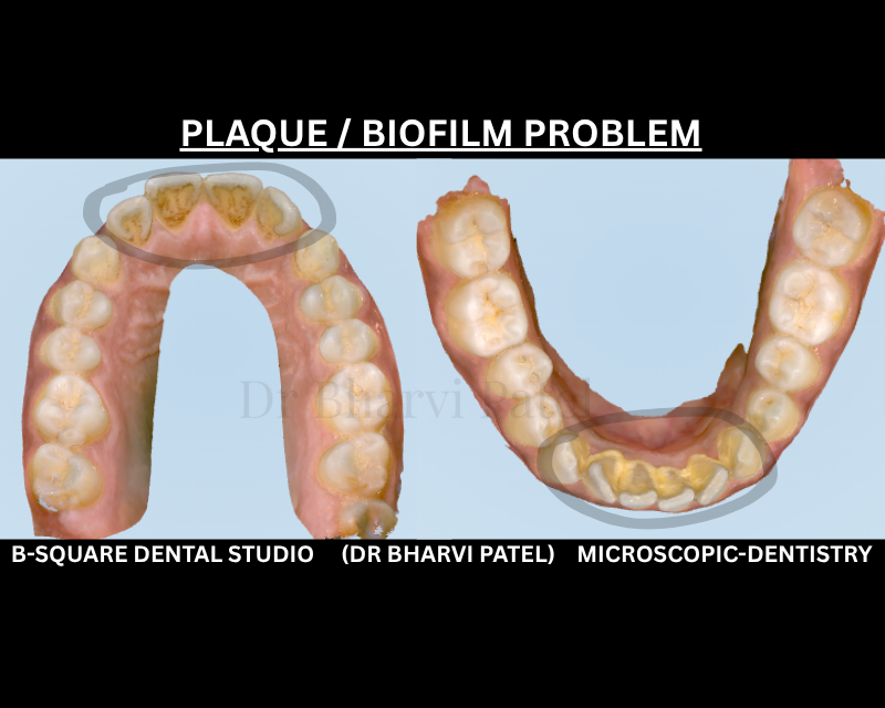Plaque isn't just leftover food it's a living colony of bacteria that starts rebuilding within hours of brushing.