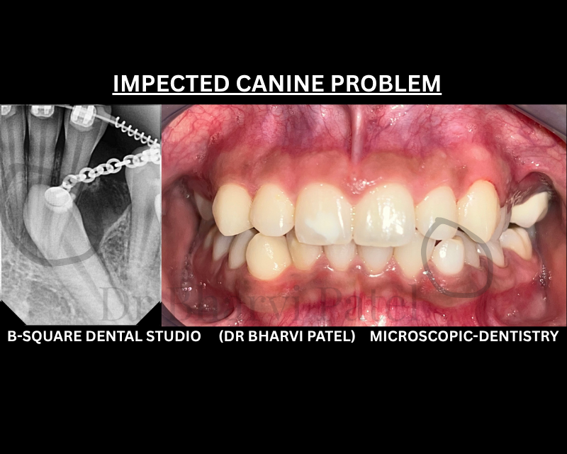 An impacted tooth isn't gone. It's just stuck and stuck teeth almost always have a path to being fixed.
