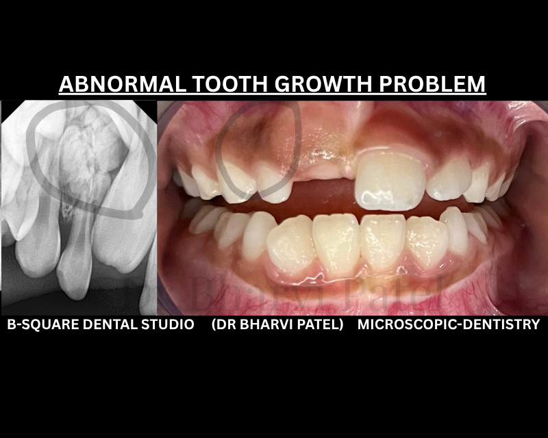 An odontoma can form silently inside the jaw for years, with zero pain, zero symptoms until a routine X-ray catches it.