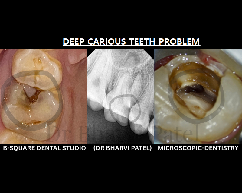 Deep decay doesn't automatically mean extraction. Often, it means saving the tooth is still very possible.
