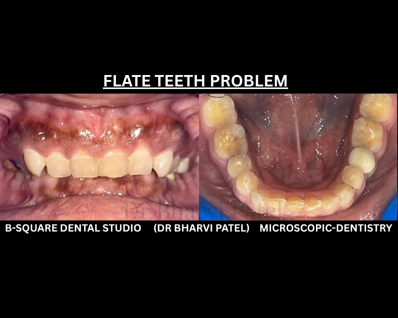 Teeth don't flatten from chewing food. They flatten from grinding against each other, usually while you sleep.