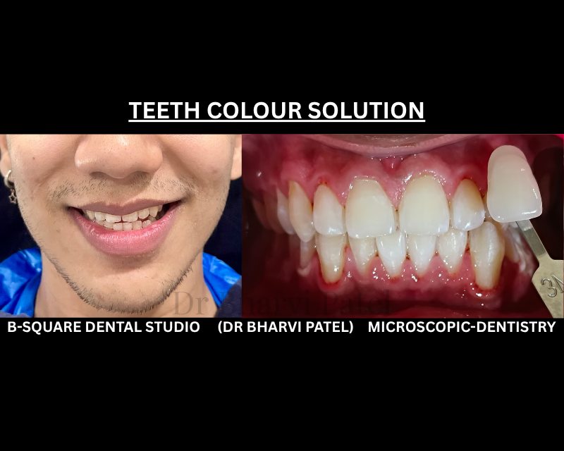 'Whitening damages your enamel' not when it's done professionally, with the right concentration and supervision.