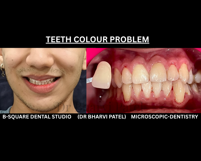 Your teeth aren't actually white to begin with natural teeth have a slight yellow undertone that just gets darker with time.