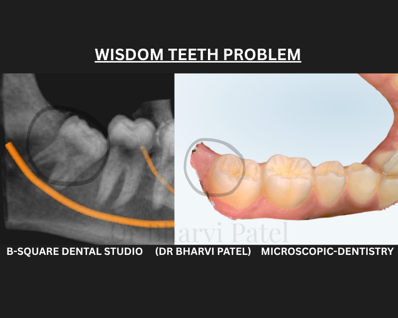 Recurring swelling or pain at the very back of your jaw, every few months?