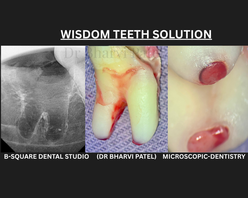 Removed early, before the roots fully form, the procedure is often simpler and recovery faster.(DISIMPACTION PROCEDURE)