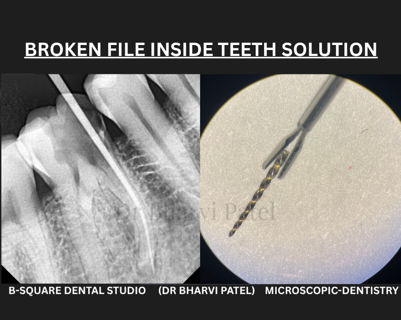 Under a dental microscope, even something this small becomes visible and often retrievable, without losing the tooth.