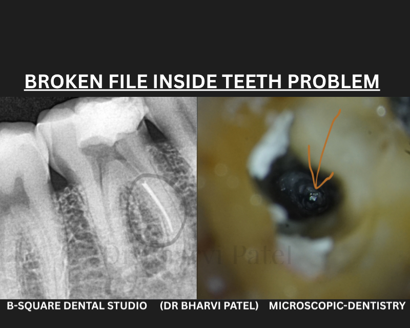 A broken file means the tooth is unsavable isn't always true under magnification, it can often be located and removed.