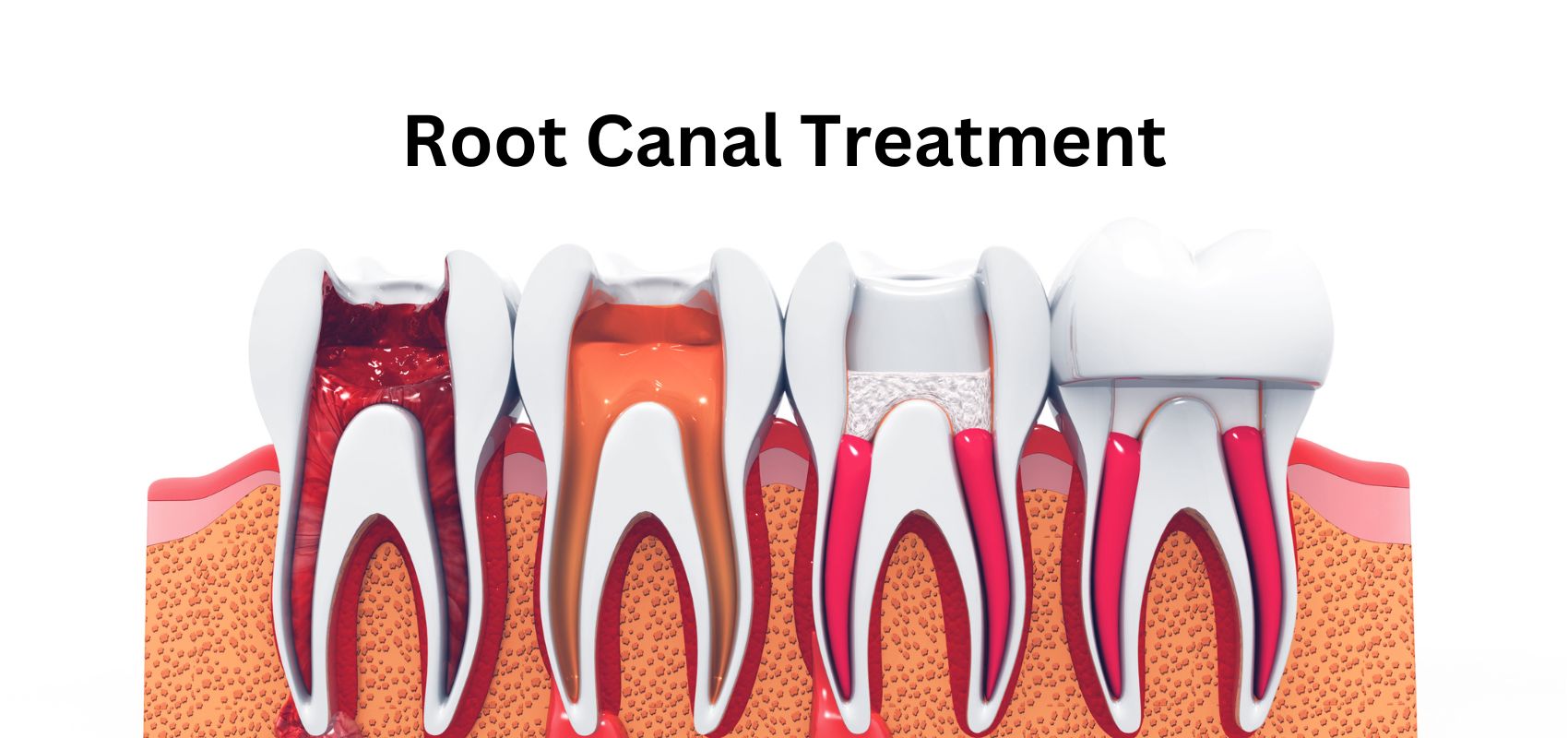 ROOT CANAL TREATMENT UNDER MICROSCOPE