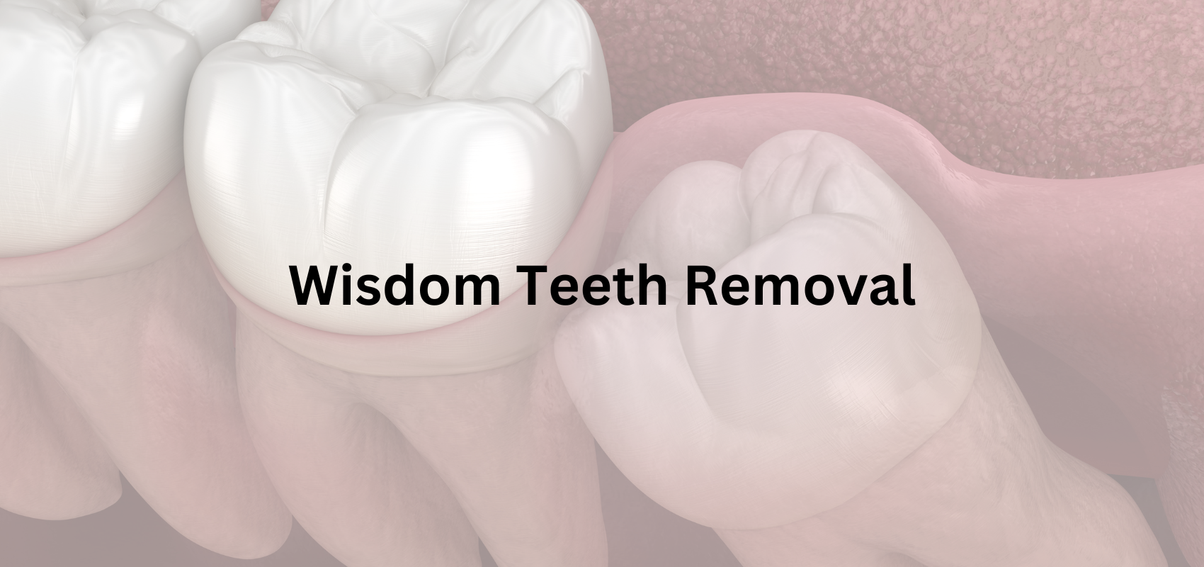 Wisdom Teeth Removal