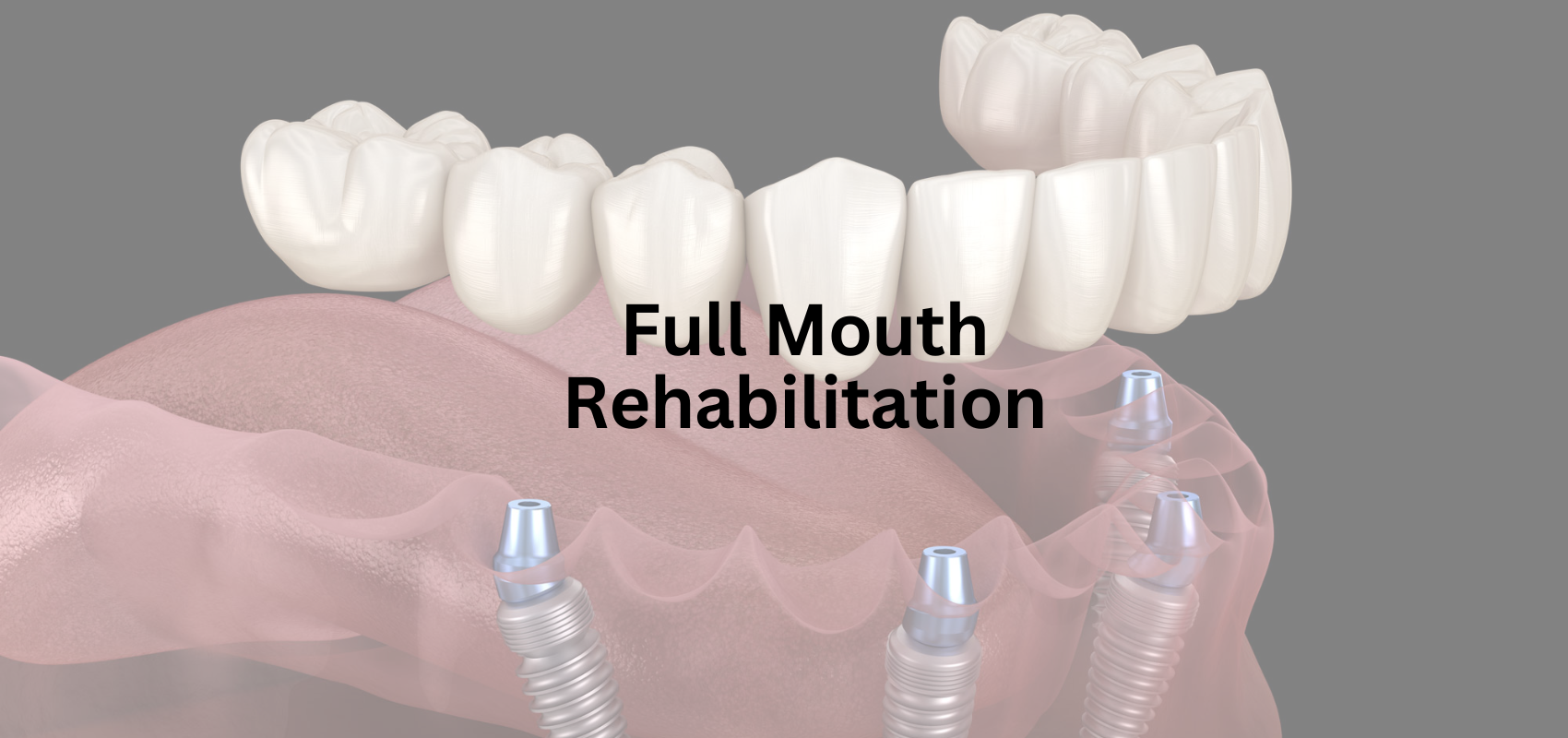 Full Mouth Rehabilitation