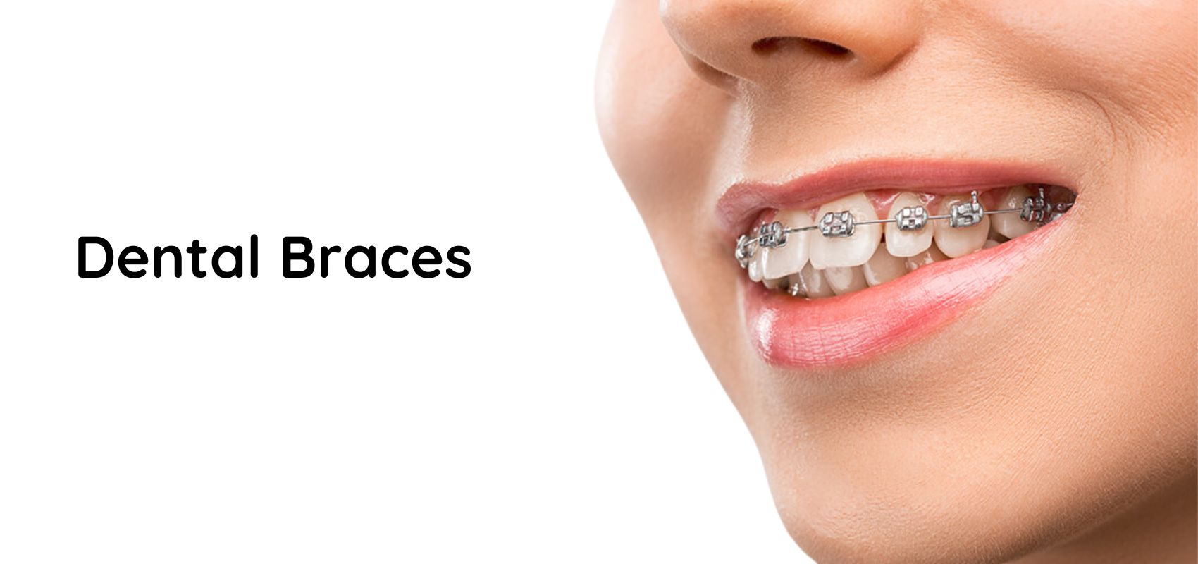 Dental Braces