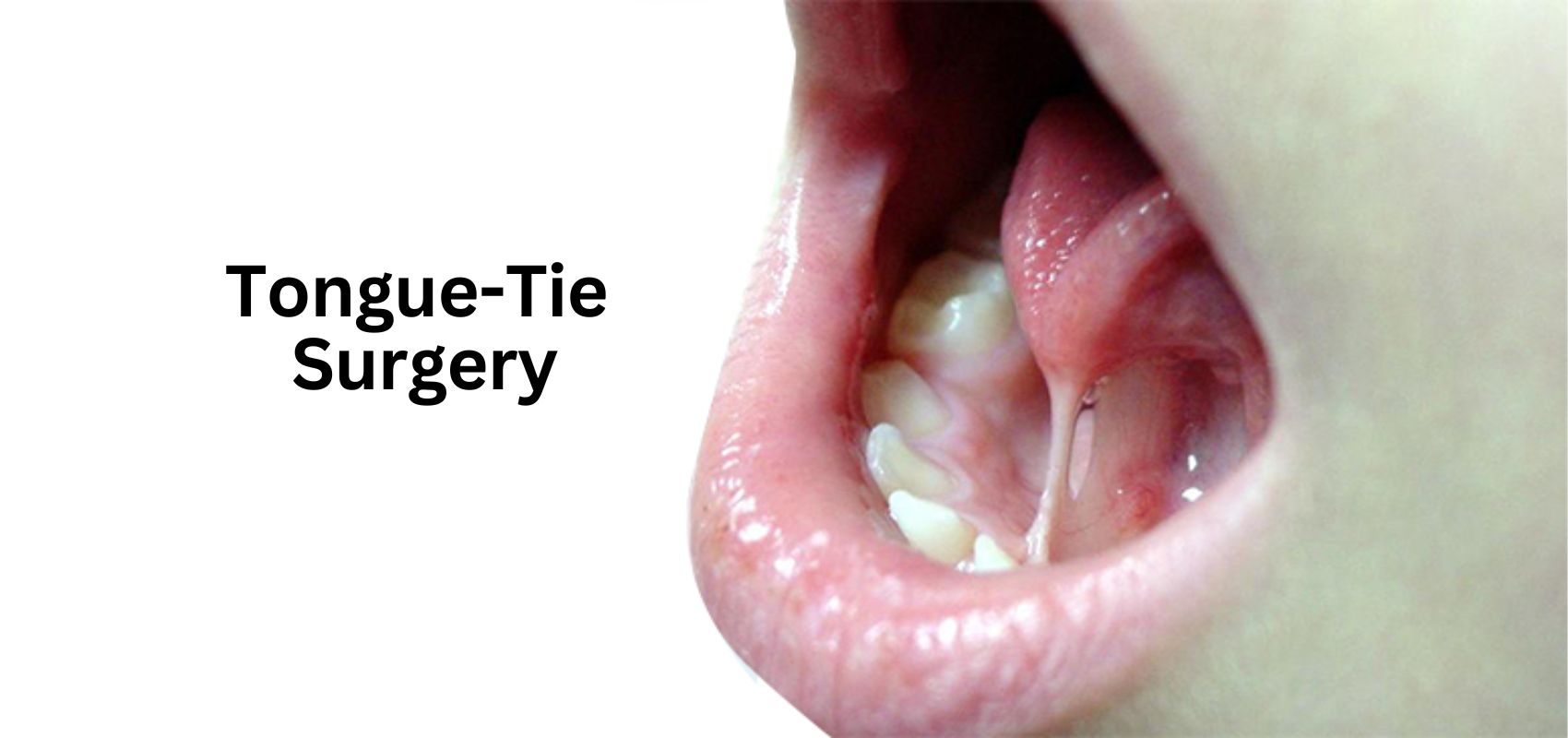 Tongue-tie Surgery